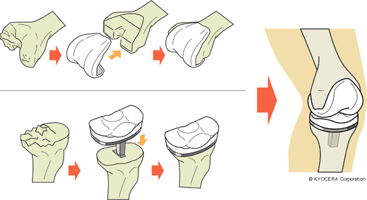 人工膝関節全置換術（TKA）