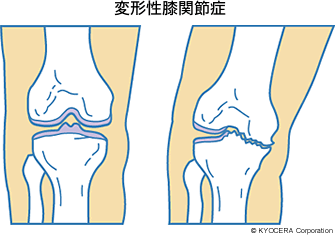 変形性膝関節症