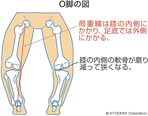 O脚の図