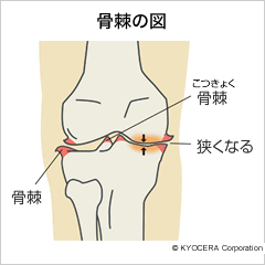 骨棘の図