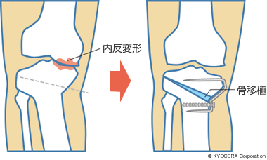 高位脛骨骨切り術（HTO）