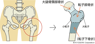 こつこつ せつ だいたい 大腿骨頚部骨折への手術方法の違いによるリスク、注意点とは？