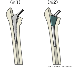 （※1）セメント固定タイプ （※2）ノンセメント固定タイプ