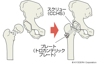CCHS＋トロカンテリックプレート 大腿骨頸部骨折（骨接合術）