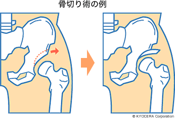 骨切り術の例