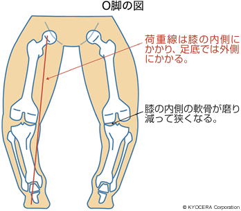 O脚の図