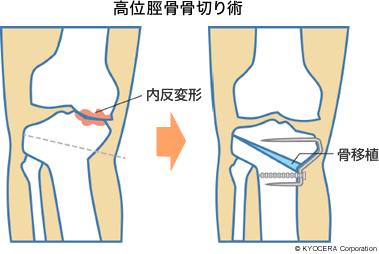 高位脛骨骨切り術