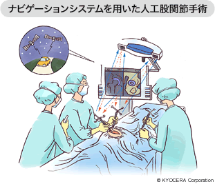 ナビゲーションシステムを用いた人工股関節手術 イラスト