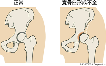 正常 寛骨臼形成不全