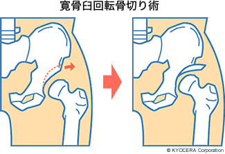 寛骨臼回転骨切り術