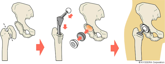 人工股関節置換術の例