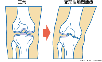 正常 変形性膝関節症