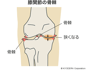 膝関節の骨棘