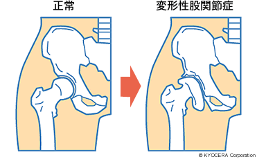 正常 変形性股関節症