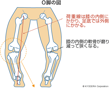 O脚の図