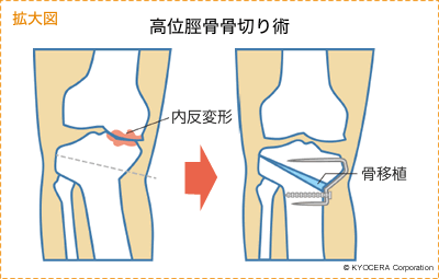 拡大図 高位脛骨骨切り術