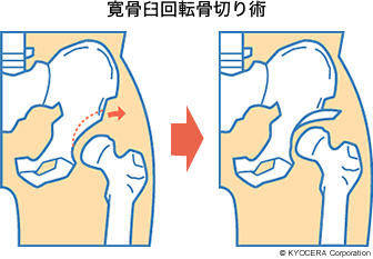 寛骨臼回転骨切り術