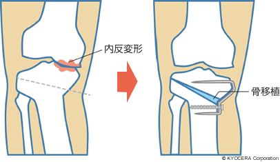 高位脛骨骨切り術（HTO）