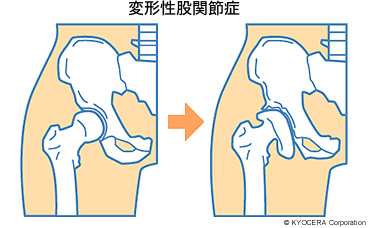 変形性股関節症