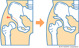 寛骨臼回転骨切り術