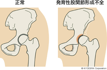 性 股関節 形成 不全 発育