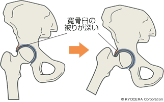 寛骨臼の被りが深い