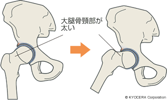 大腿骨頸部が太い