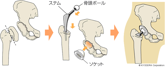 人工股関節手術