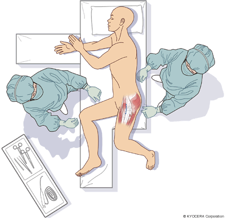 OCM（側臥位前側方アプローチ）