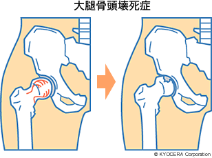 大腿骨頭壊死症