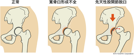 正常 寛骨臼形成不全 先天性股関節脱臼
