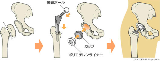 人工股関節