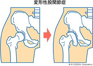 変形性股関節症