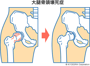 大腿骨頭壊死症