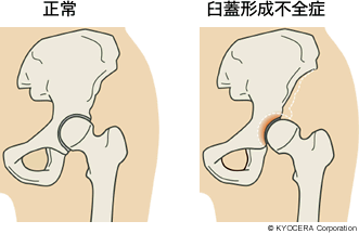 正常 臼蓋形成不全症