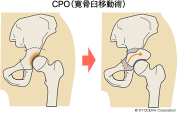 CPO（寛骨臼移動術）