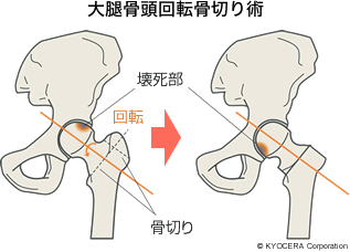 大腿骨頭回転骨切り術