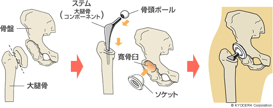 セメントタイプの人工股関節