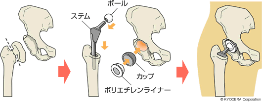 セメントレスタイプの人工股関節