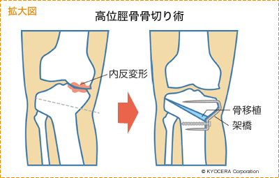 高位脛骨骨切り術