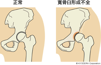 正常 寛骨臼形成不全