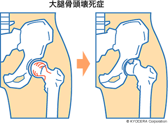 大腿骨頭壊死症