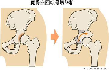 寛骨臼回転骨切り術