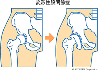 変形性股関節症