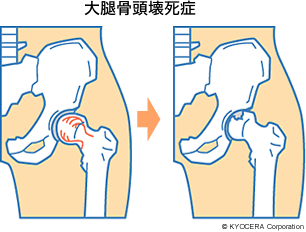 大腿骨頭壊死症