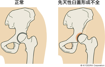 正常 先天性臼蓋形成不全