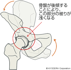 骨盤の後傾イメージ（大腿骨頭前方の接触面の被りが浅くなる）