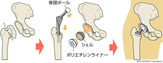 セメントレス人工股関節