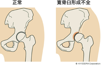 正常 寛骨臼形成不全