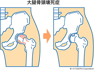 大腿骨頭壊死症